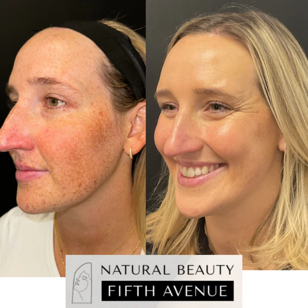 Before and after sun damage treatment: left shows facial redness and discoloration, right shows cleared, smooth skin with improved complexion